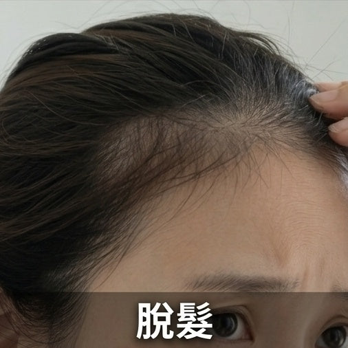 脫髮危機